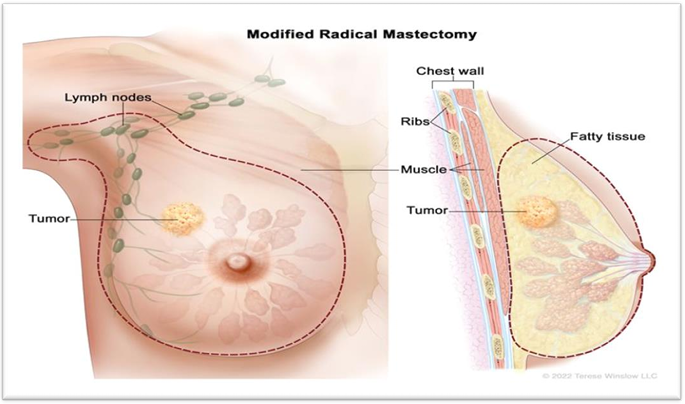 Breast cancer treatment method diagram